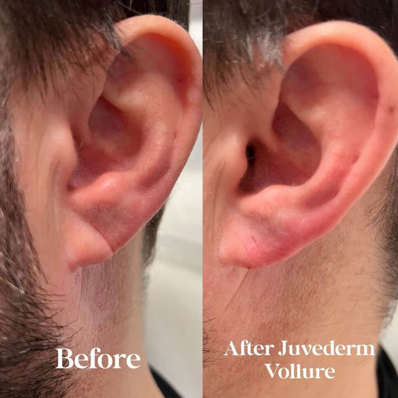 Before and after photos of Juvederm Vollure on a man's ear
