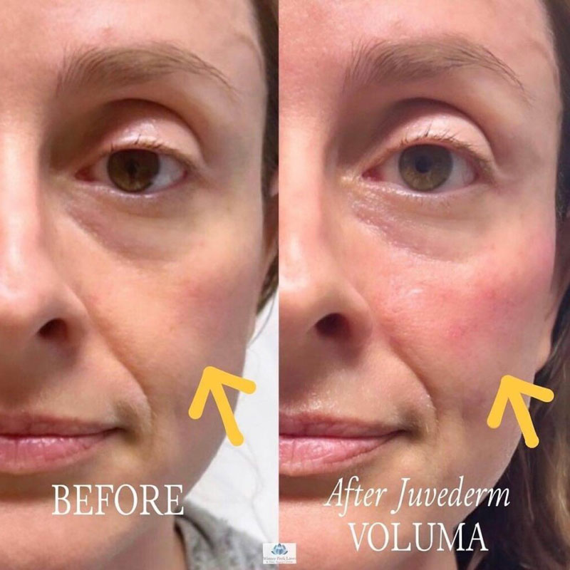 Before and after photos of a woman's cheek with Juvederm Voluma filler