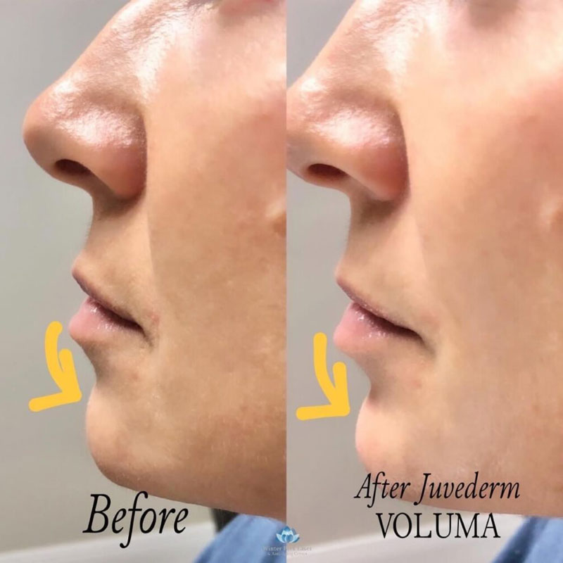 Before and after photos of a chin that had Juvederm Voluma filler
