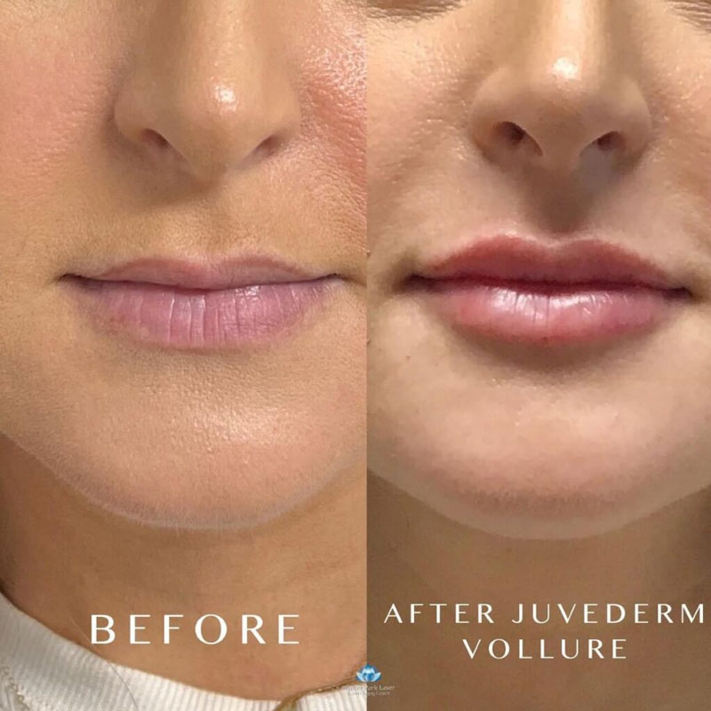 Before and after photos of lips after Juvederm Vollure filler