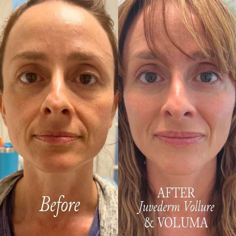 Before and after photos of a woman's face after Juvederm Vollure and Voluma fillers