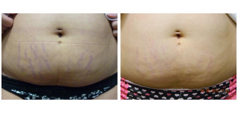 Before and after stretch mark removal on a person's stomach