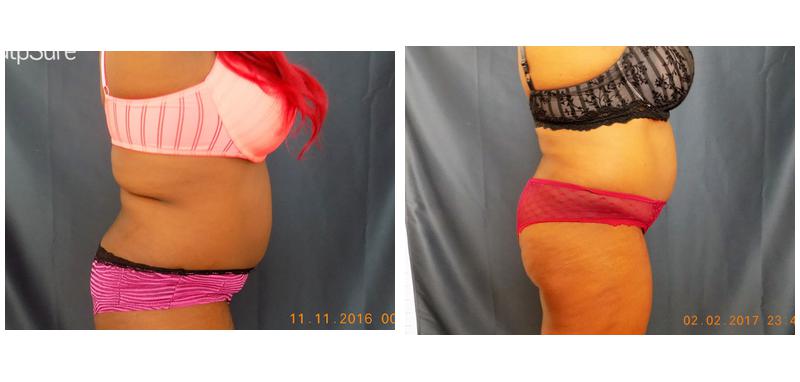 A woman's stomach and back before and twelve weeks after first SculpSure series