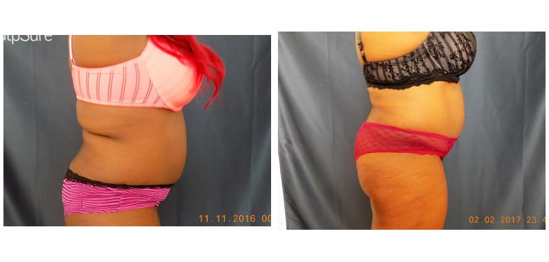 Woman's Stomach and Back Before and After View of SculpSure Treatment in Winter Park, FL