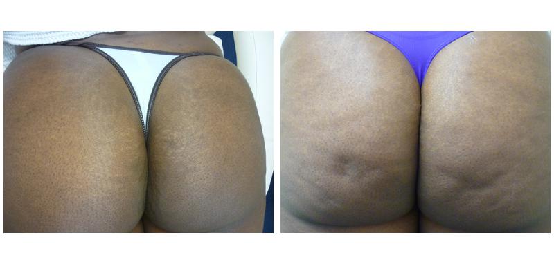Before and after stretch mark removal on a person's bottom