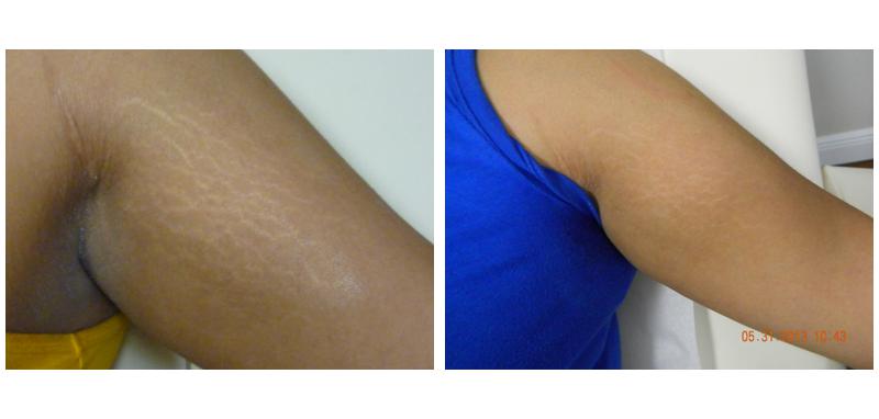 Before and after stretch mark removal on a person's arm
