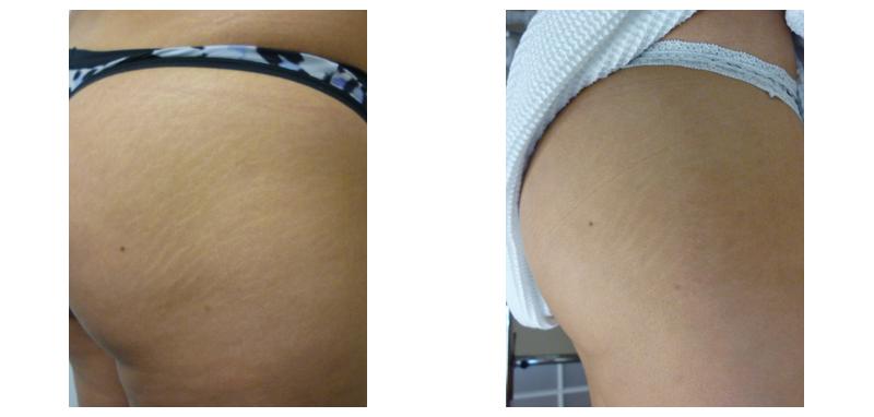 Before and after stretch mark removal on a woman's bottom and thigh