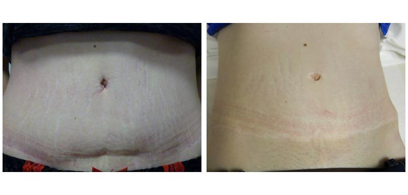 Before and after stretch mark removal on a person's stomach