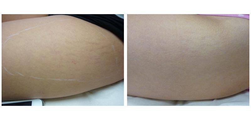 Before and after stretch mark removal on a person's thigh