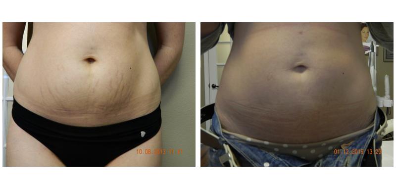 Before and after stretch mark removal on a woman's stomach
