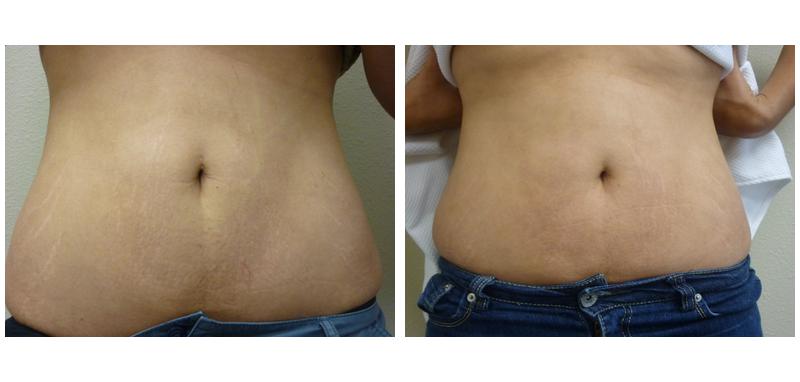 Before and after stretch mark removal on a woman's stomach