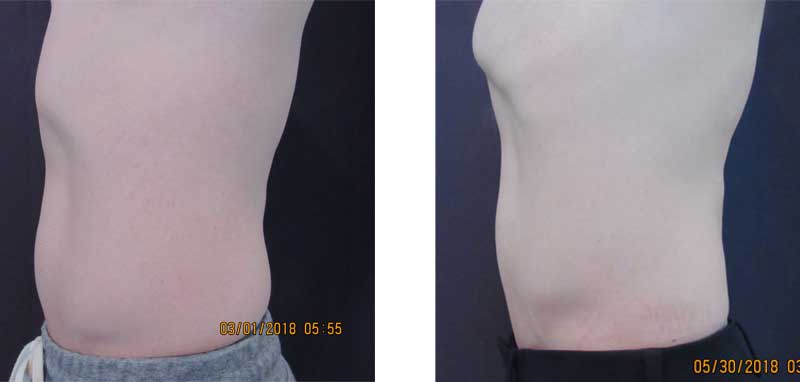 A man's side profile before and after Sculpsure treatment