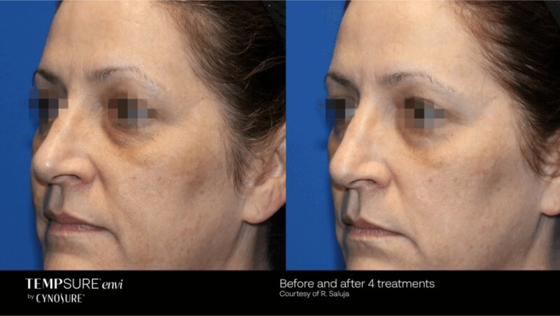Patient before and after four TempSure Envi treatments at Winter Park Laser