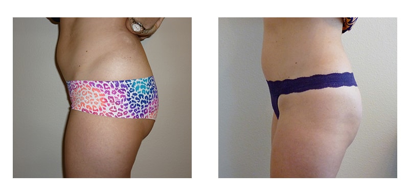 A woman's side torso before and after VelaShape Trusculpt treatment