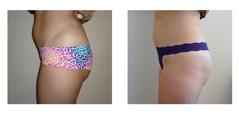 A woman's side torso before and after VelaShape Trusculpt treatment