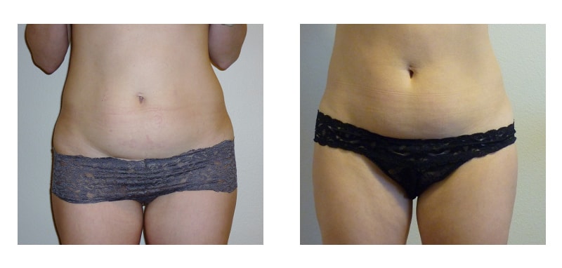 A woman's stomach before and after VelaShape Trusculpt treatment