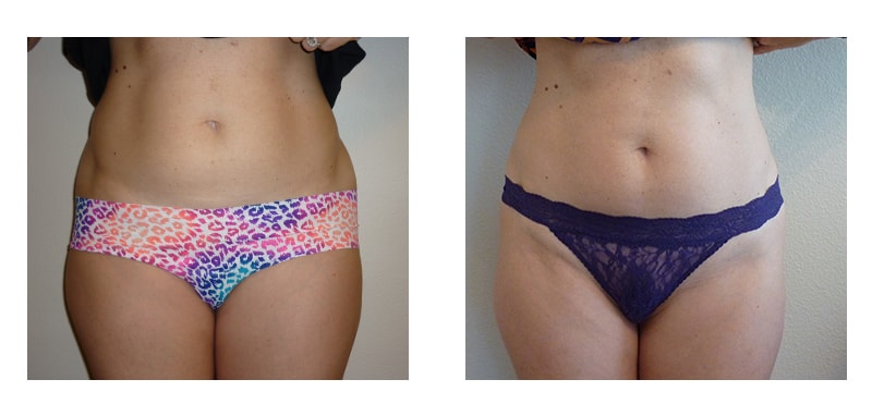 A woman's stomach before and after VelaShape Trusculpt treatment