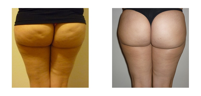 Butt and thighs before and after VelaShape Trusculpt treatment