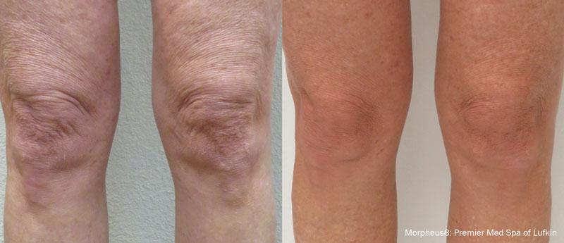 Morpheus8 before and after treatment photos around a person's knees