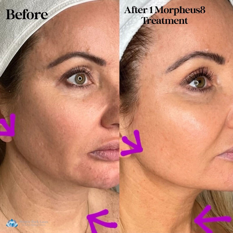 before and after treatment photos of a woman's jawline and neck with Morpheus8