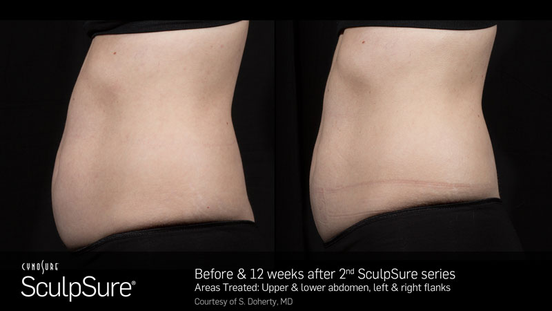 Before and After View of Sculpsure Body Fat Treatment of Woman's Stomach in Winter Park, FL