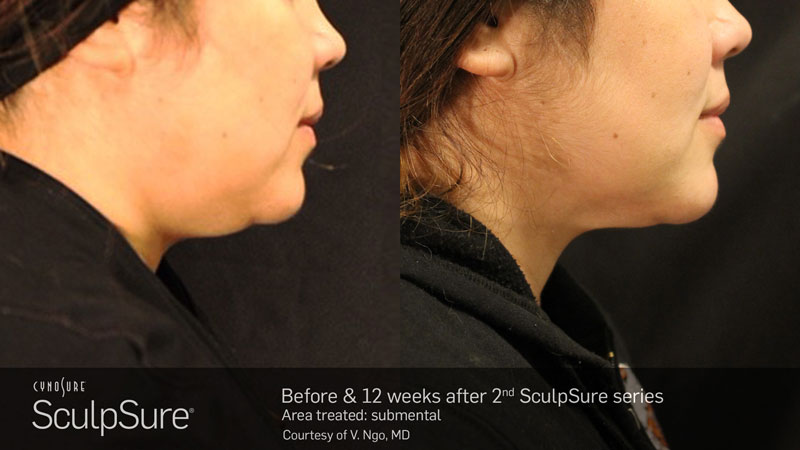 Before and after treatment photos of a woman's neck side profile