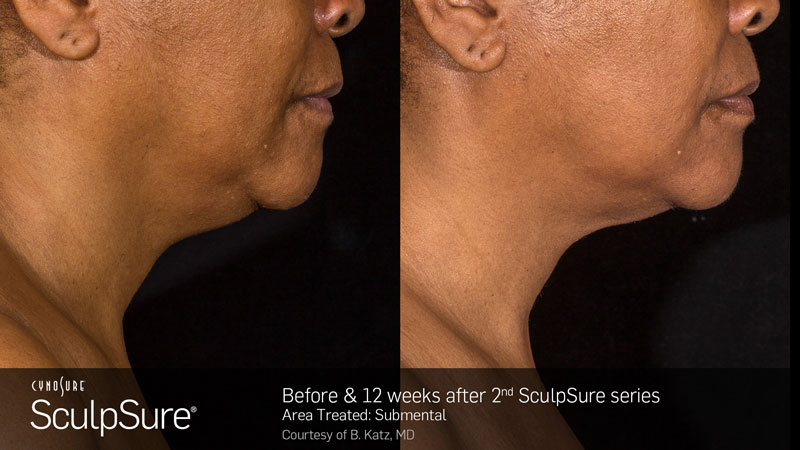 Before and after treatment photos of a woman's neck side profile