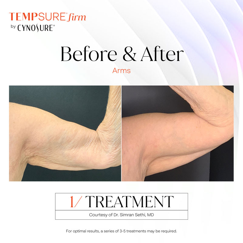 TempSure Firm before and after treatment photos of person's bicep