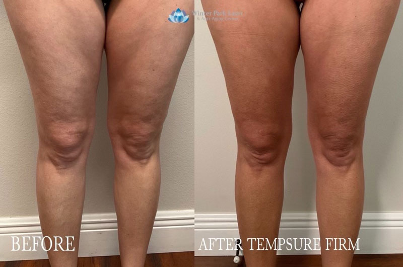 TempSure Firm before and after treatment photos of woman's legs