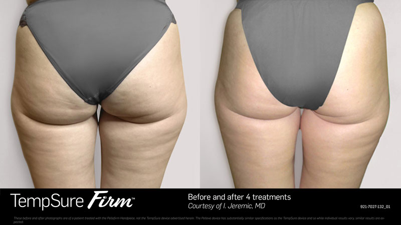 TempSure Firm before and after treatment photos of woman's buttocks