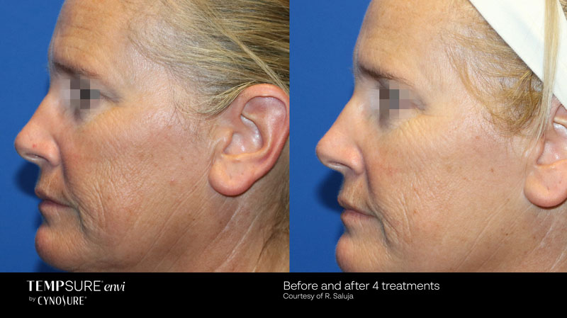 TempSure Envi before and after photos of woman's cheek