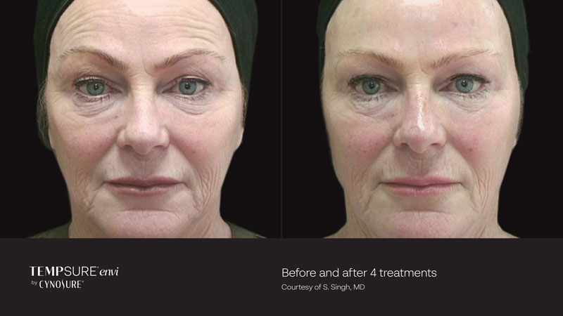 TempSure Envi before and after treatment photos on woman's face