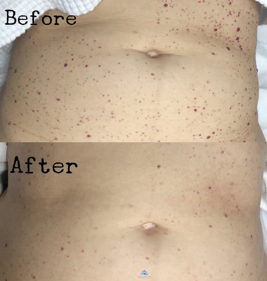 Person's stomach before and after IPL treatment