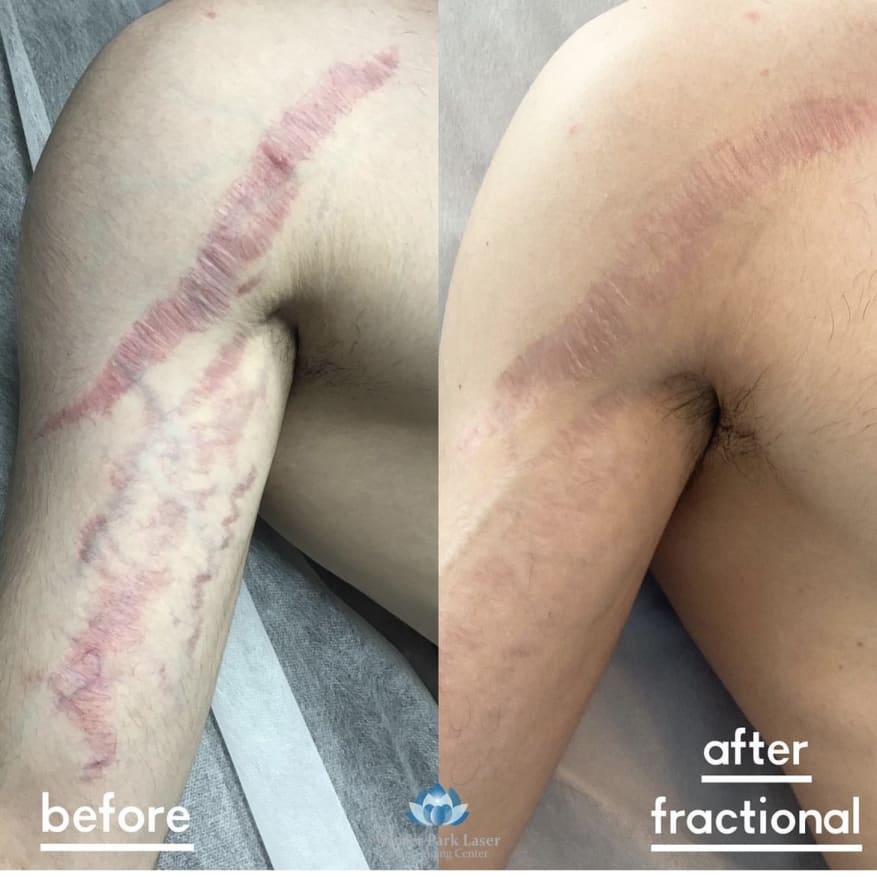 Man's arm scar before and after IPL treatment