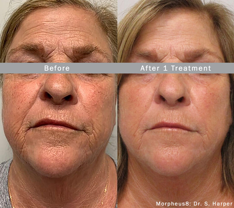 Before and after Morpheus8 treatment on face