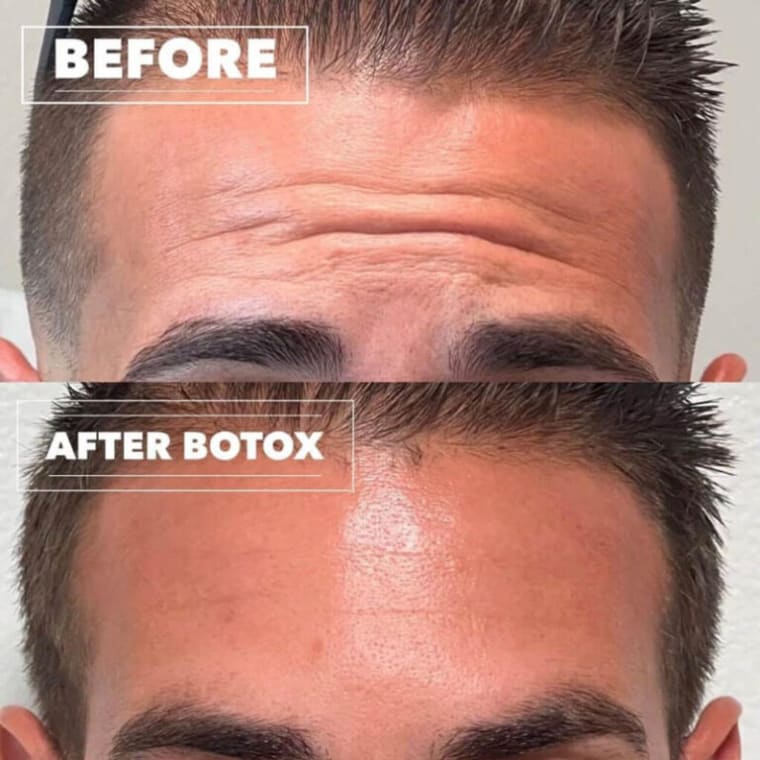 Forehead wrinkles before and after Botox injections