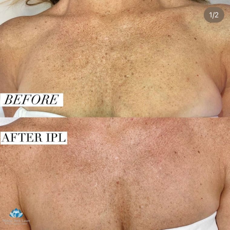 Before and after images of a woman's chest after IPL treatment