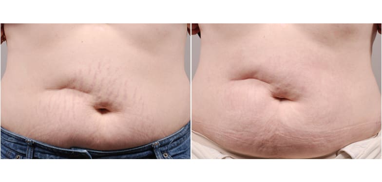 Before and after stretch mark removal on a person's stomach